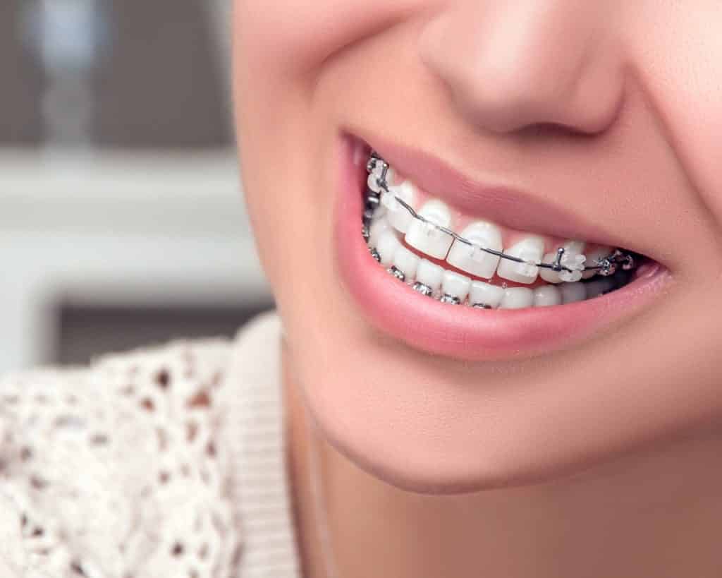 woman wearing clear braces