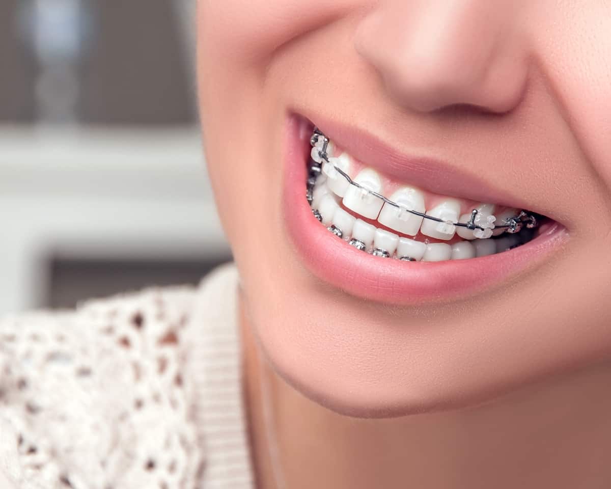 woman wearing clear braces