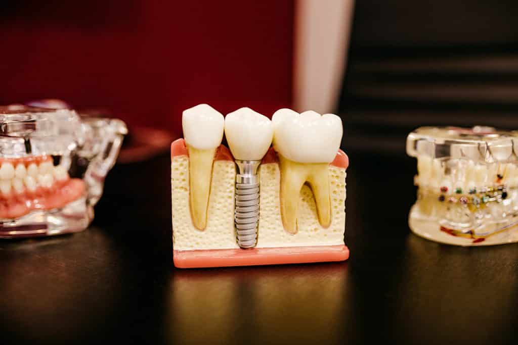 DENTAL IMPLANT