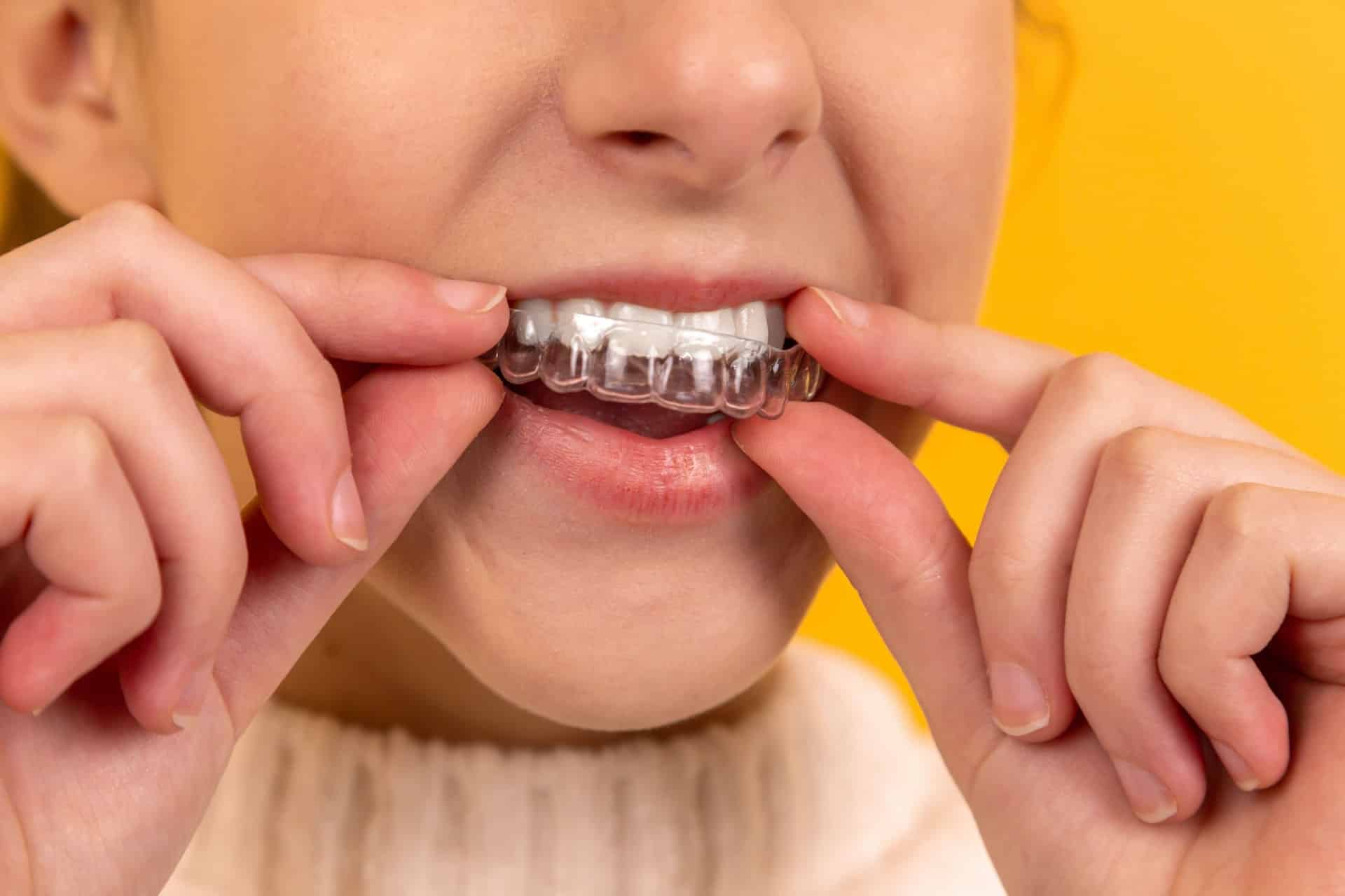 Invisible aligners being worn by a patient