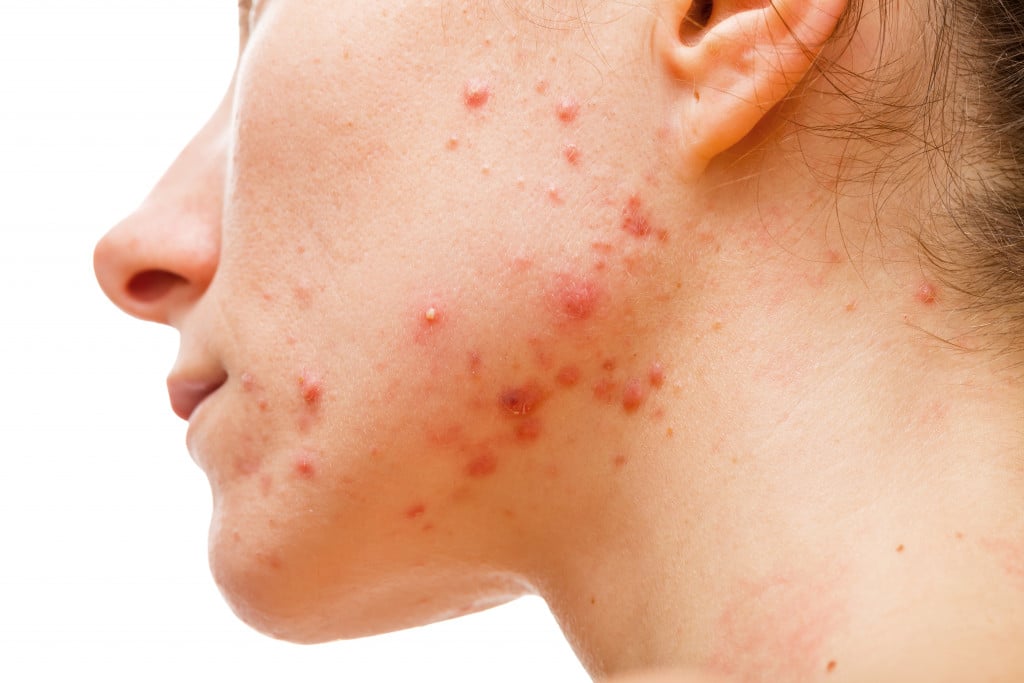 Acne growth in woman